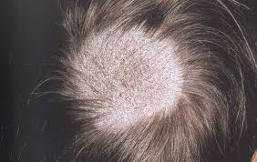scalp fungus infectiongrey patch