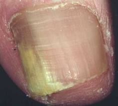 nail fungus
