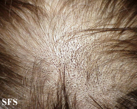 black dot scalp fungal infection