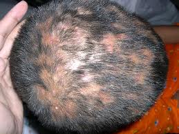diffuse pustular scalp fungus
