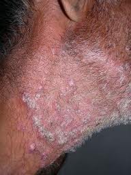 tinea fungal infection on beard