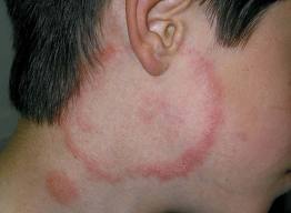 tinea fungal infection on face