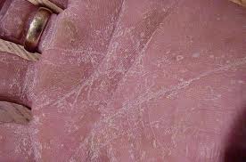 tinea fungal infection on hand