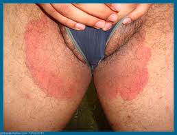 fungal infection of groin