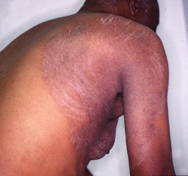 Tinea infection body