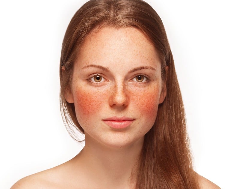 rosacea1