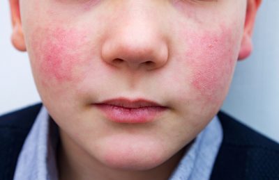 rosacea2